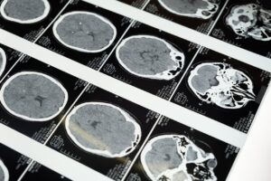 Brain MRI scan representing the shingles vaccine dementia study