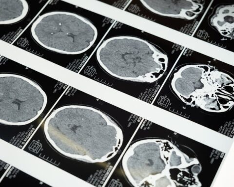 Brain MRI scan representing the shingles vaccine dementia study