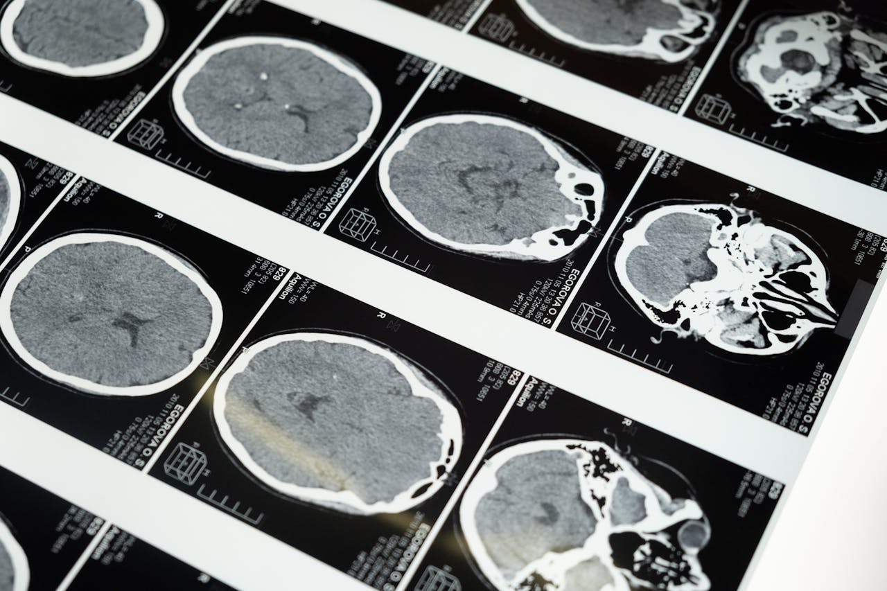 Representative Image. MRI Images of the Brain. Photo Source: Pexels