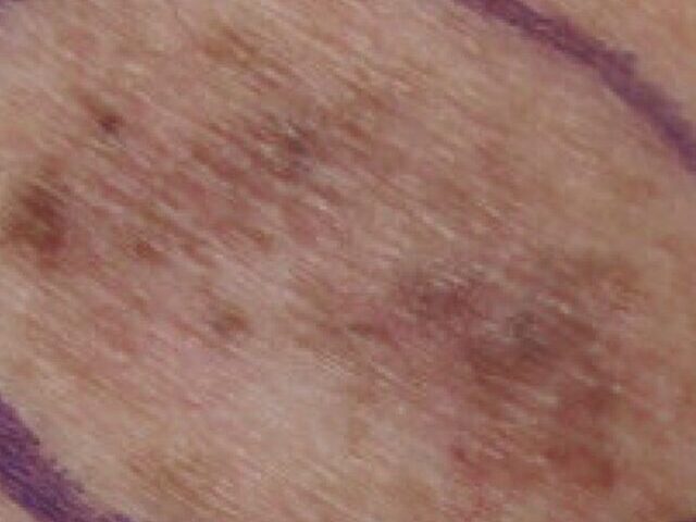 Representative Image: Malignant Melanoma in situ, right upper medial back, marked for biopsy Photo Source: Dermanonymous (CC BY-SA 4.0)