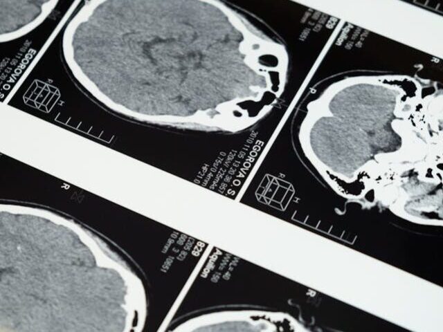 Representative Image. MRI Images of the Brain. Photo Source: Pexels