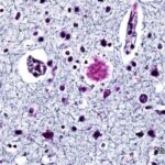 Alzheimer dementia (2) presenile onset