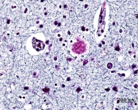 Alzheimer dementia (2) presenile onset