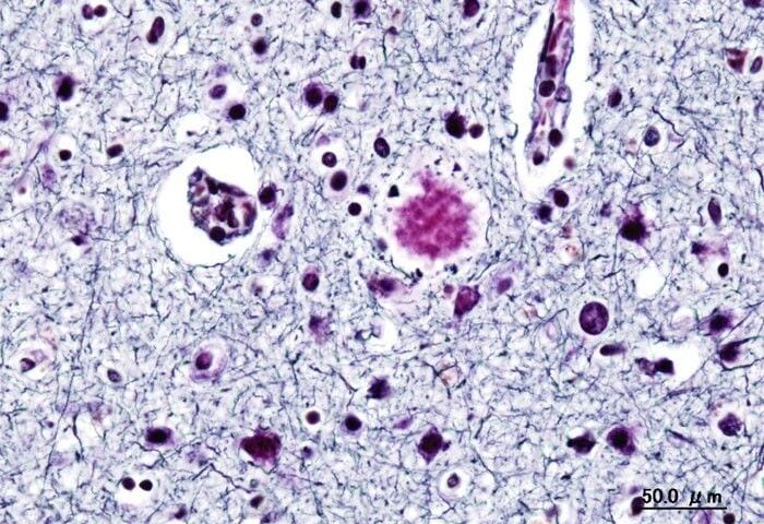 Alzheimer dementia (2) presenile onset