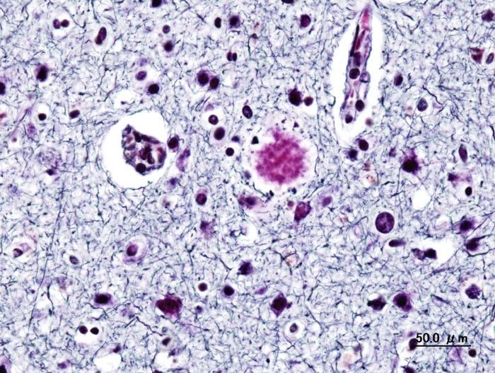 Alzheimer dementia (2) presenile onset
