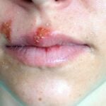 Cold Sores. Photo Source: Picryl.