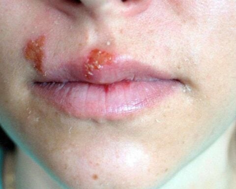 Cold Sores. Photo Source: Picryl.