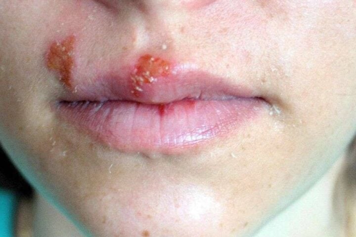 Cold Sores. Photo Source: Picryl.