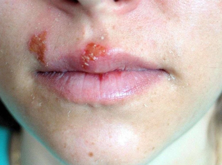 Cold Sores. Photo Source: Picryl.