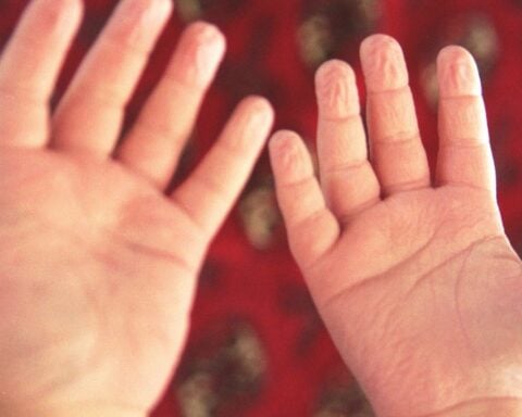 Representative image:- wrinkled finger- Photo Source :- Flicker - Photo Credit:- artfulblogger
