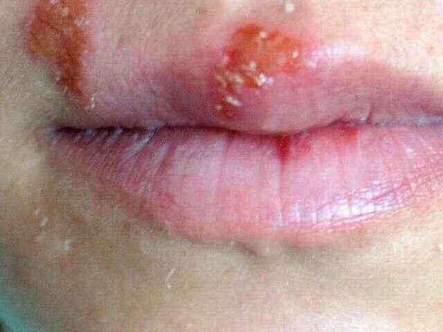 Cold Sores. Photo Source: Picryl.