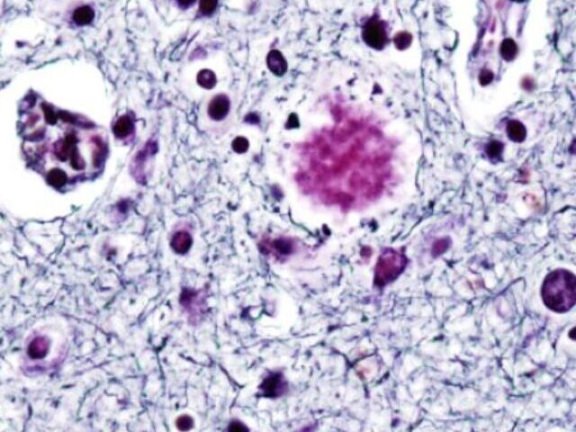 cropped-HSV-1-Boosts-Alzheimers-Risk-80-Antivirals-Cut-It-17-14.jpg
