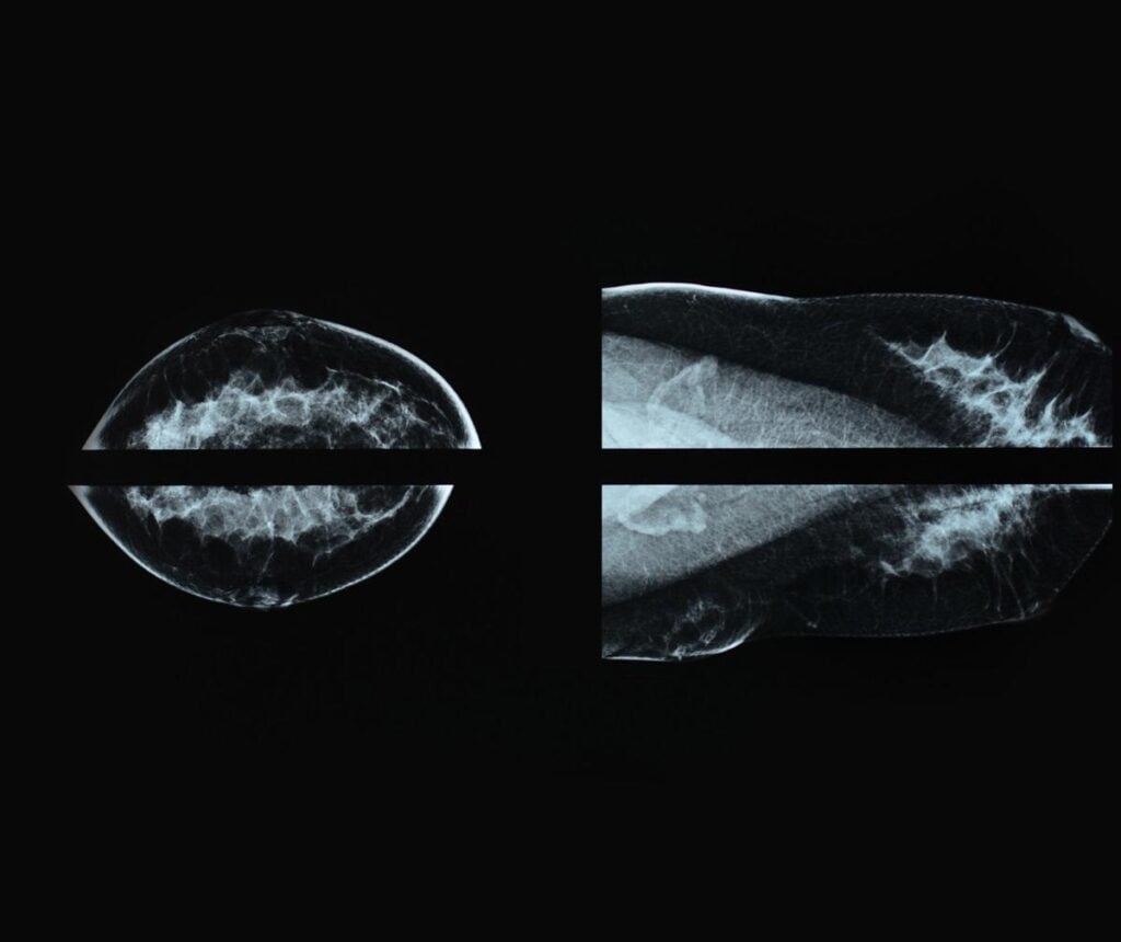 Representative Image: breast cancer patients screening Photo Source: Sitthijate Poonboon