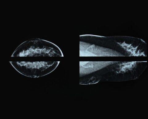 Representative Image: breast cancer patients screening Photo Source: Sitthijate Poonboon