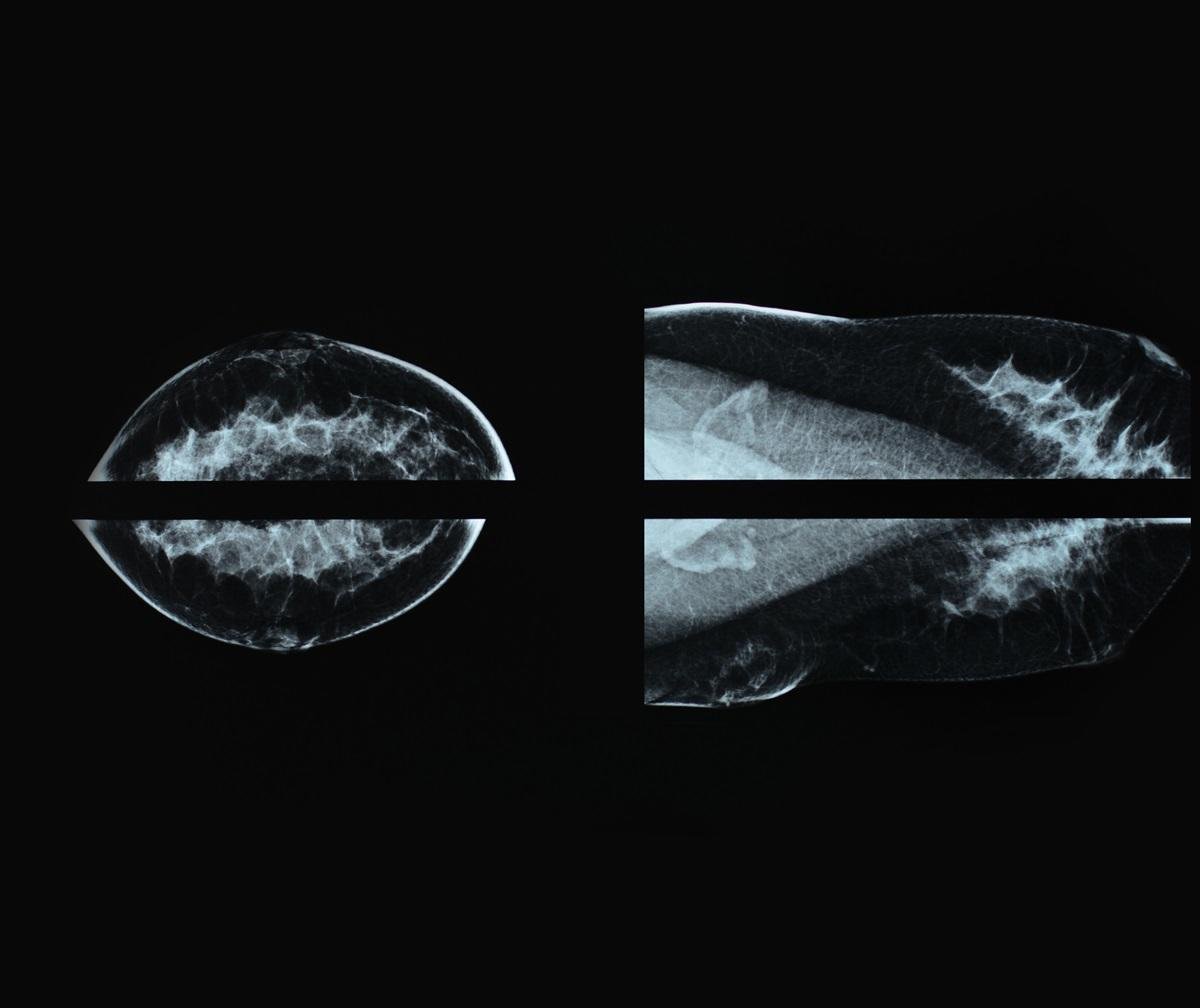 Representative Image: breast cancer patients screening Photo Source: Sitthijate Poonboon