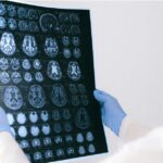 Doctor holding up an MRI Repot of brain.