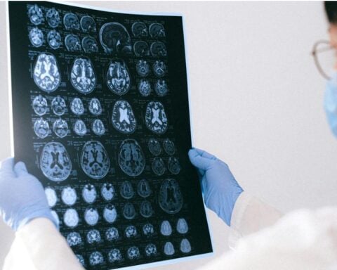 Doctor holding up an MRI Repot of brain.