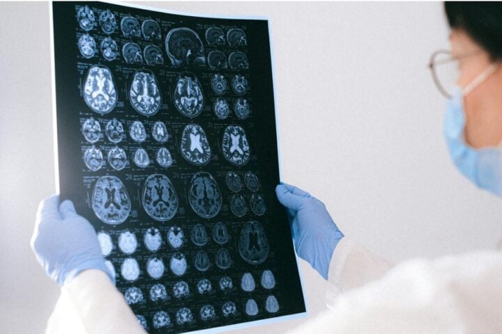 Doctor holding up an MRI Repot of brain.