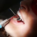 Dentist wearing gloves checking a patient’s teeth with a dental mirror in a clinical setting.