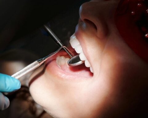 Dentist wearing gloves checking a patient’s teeth with a dental mirror in a clinical setting.