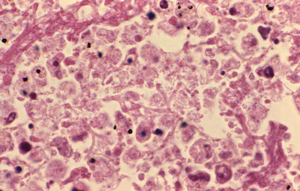 Lung tissue during legionellosis