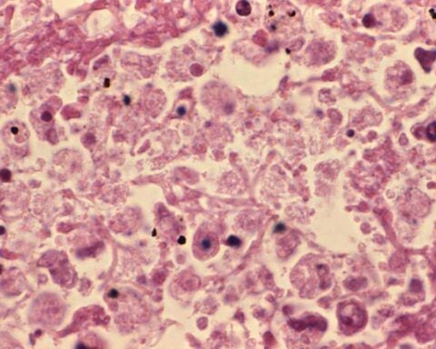 Lung tissue during legionellosis