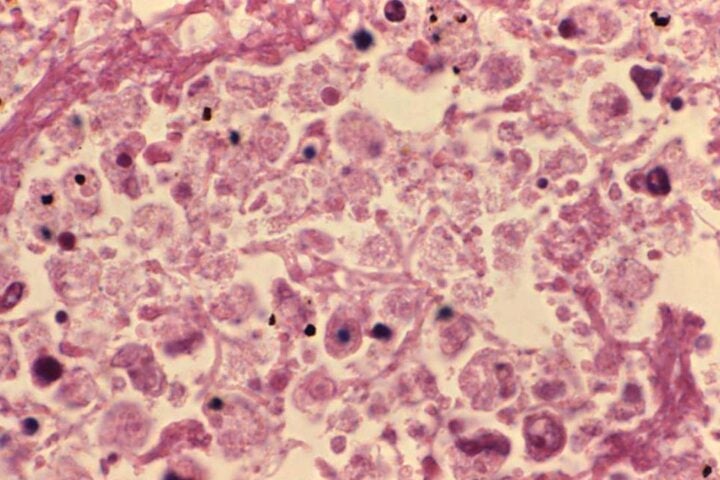 Lung tissue during legionellosis