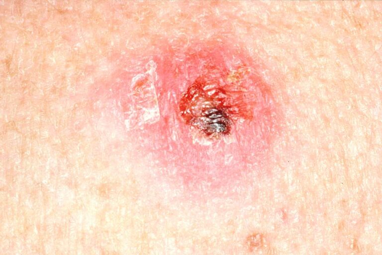 New AI Spots Skin Cancer Before Doctors Can See It: How PanDerm ...