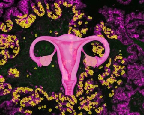 The female reproductive system as focus of this study in the background of a serous Borderline tumor. Photo Source: Lisa Schweizer, MPI of Biochemistry