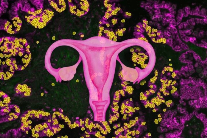 The female reproductive system as focus of this study in the background of a serous Borderline tumor. Photo Source: Lisa Schweizer, MPI of Biochemistry