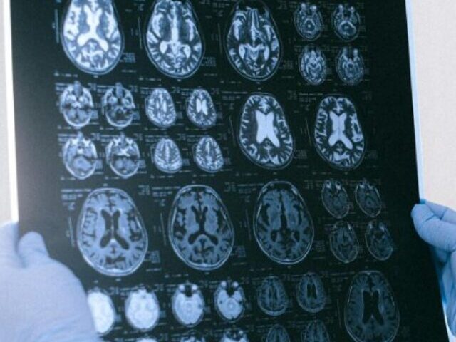 Brain Tumor Medication Linked to Gambling and Hypersexuality University of Birmingham Study Reveals