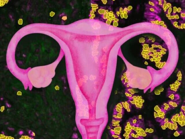 New Ovarian Cancer Therapy Triples Response Rate vs Chemotherapy (8)