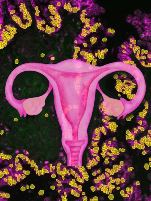 New Ovarian Cancer Therapy Triples Response Rate vs Chemotherapy
