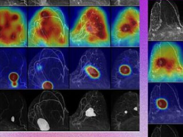 cropped-Microsofts-New-AI-Breast-MRI-Model-Slashes-False-Positives-by-25-Provides-Visual-Explanation-Maps.jpg