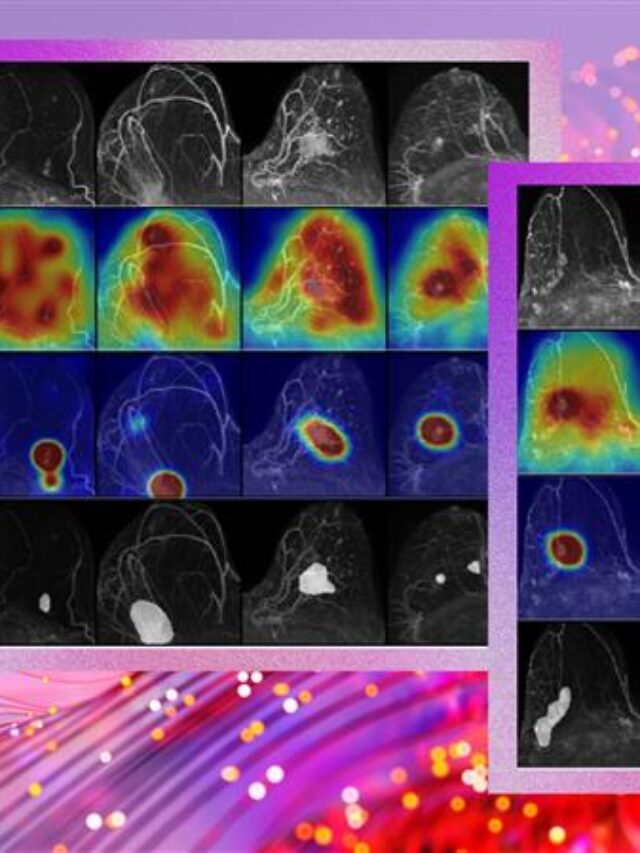 AI Breast Cancer Model Cuts False Positives by 25% in MRI Screening