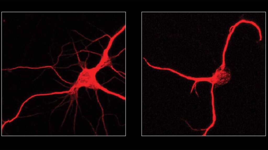 Fluorescent microscopy images comparing two neurons: left shows a healthy neuron with multiple branching extensions, right shows a neuron with fewer, simpler extensions after FTL1 protein exposure.