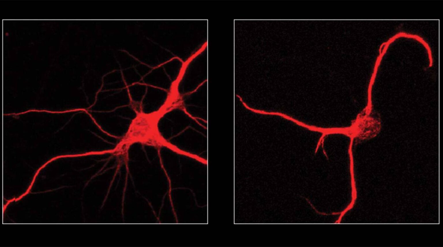 Fluorescent microscopy images comparing two neurons: left shows a healthy neuron with multiple branching extensions, right shows a neuron with fewer, simpler extensions after FTL1 protein exposure.