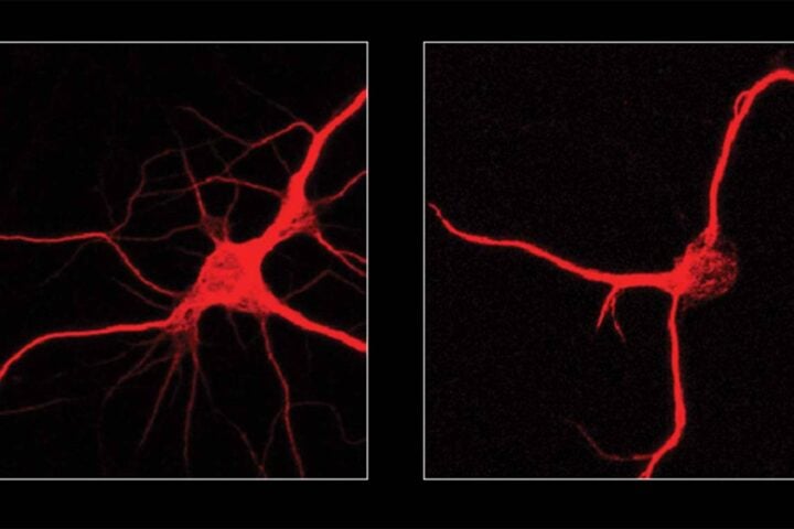 Fluorescent microscopy images comparing two neurons: left shows a healthy neuron with multiple branching extensions, right shows a neuron with fewer, simpler extensions after FTL1 protein exposure.