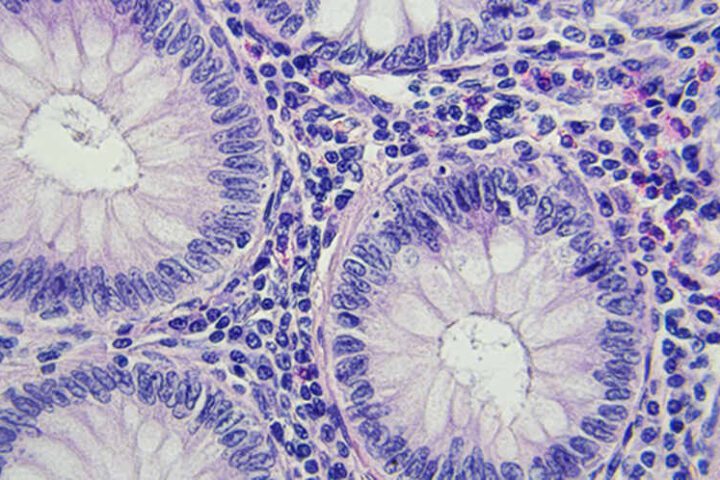 Microscopic image of colorectal cancer tissue showing circular glandular structures surrounded by densely packed cells stained purple.