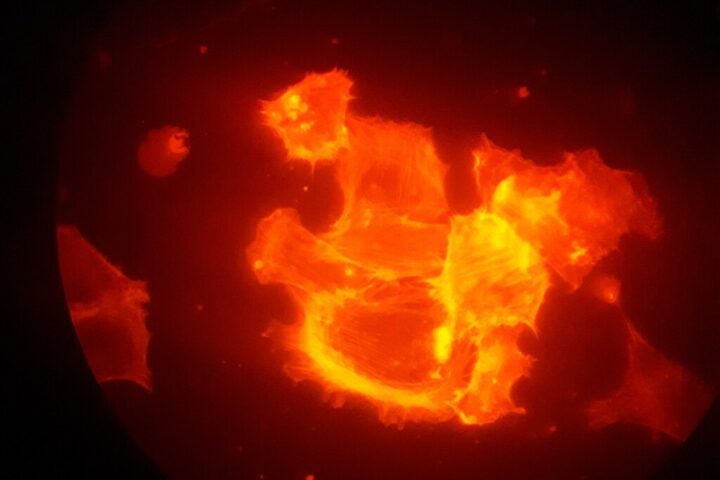 Fluorescent microscopy image of orange-red cancer cells growing in media containing ribohistatin, showing their clustered structure against a dark background.