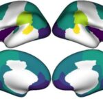 A scientific image displaying four different views of a human brain, color-coded to indicate varying cortical thickness. Darker colors represent areas with a greater reduction in cortical thickness, which is linked to societal income inequality.