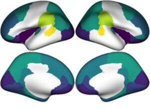 A scientific image displaying four different views of a human brain, color-coded to indicate varying cortical thickness. Darker colors represent areas with a greater reduction in cortical thickness, which is linked to societal income inequality.