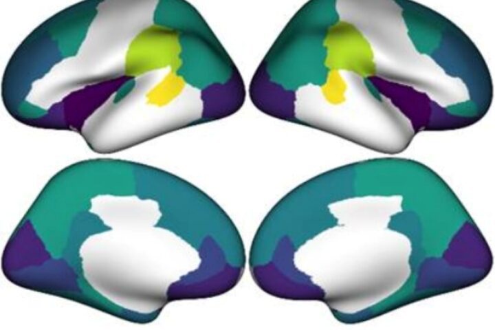 A scientific image displaying four different views of a human brain, color-coded to indicate varying cortical thickness. Darker colors represent areas with a greater reduction in cortical thickness, which is linked to societal income inequality.