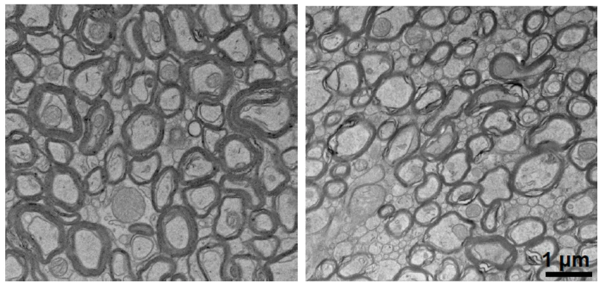 Electron microscopy showing myelin differences with lithium deficiency