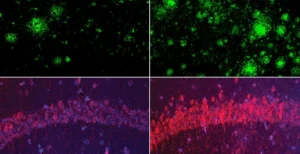 Fluorescence microscopy panels comparing Alzheimer’s mouse brain tissue show more amyloid-beta deposits and stronger tau staining when lithium is deficient versus normal levels. Harvard Medical School