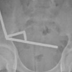 Abdominal X-ray overview indicating multiple magnet chains in a New Zealand case (NZMJ, 2025)