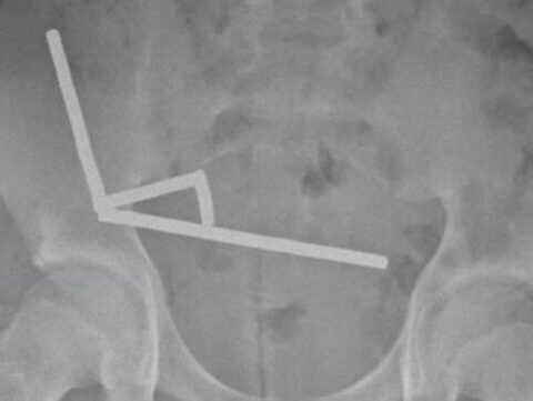 Abdominal X-ray overview indicating multiple magnet chains in a New Zealand case (NZMJ, 2025)