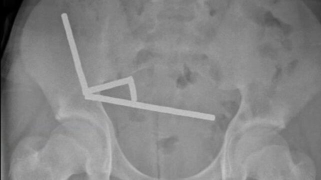 Abdominal X-ray overview indicating multiple magnet chains in a New Zealand case (NZMJ, 2025)