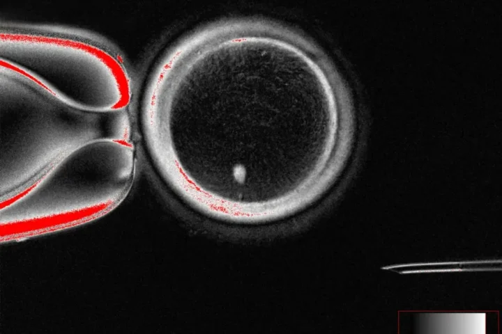 Microscopic image showing a human oocyte with a bright image of a skin cell nucleus inside, before fertilization.