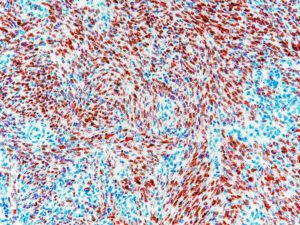 Microscopic image of Kaposi sarcoma tissue showing HHV-8 Latency-Associated Nuclear Antigen (LANA) expression with dark red stained nuclei and blue counterstained LANA-negative nuclei, displaying spindle cell formation in a pediatric lymph node sample.